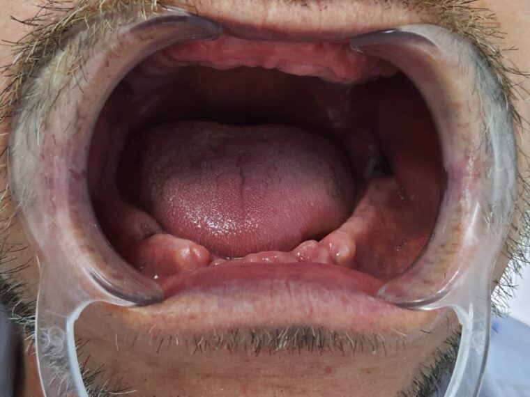 Lucrare All-on-4 pe implanturi dentare, arcadă completă