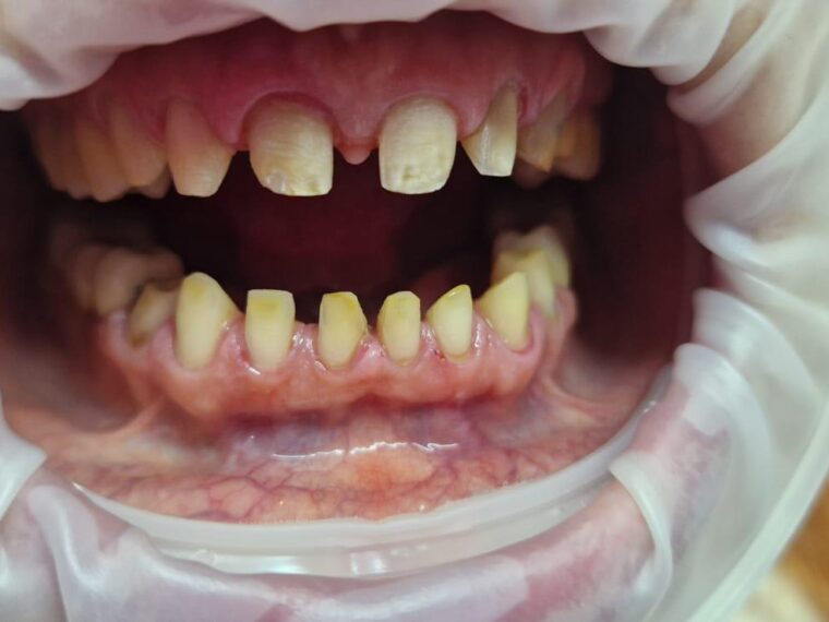 Caz clinic după — lucrare din ceramică E-Max pe zirconiu