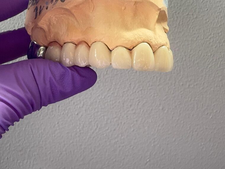 Caz clinic după — proteză metalo-ceramică pe 6 implanturi