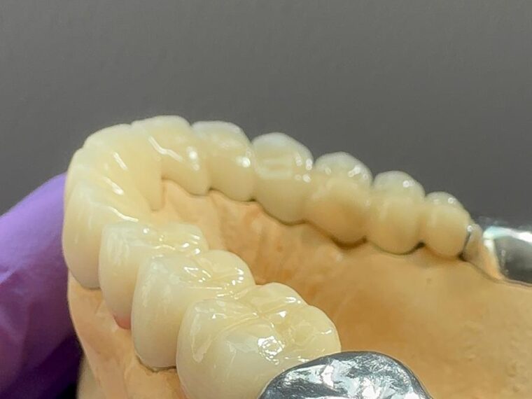 Caz clinic după tratament — punte metalo-ceramică de 12 elemente