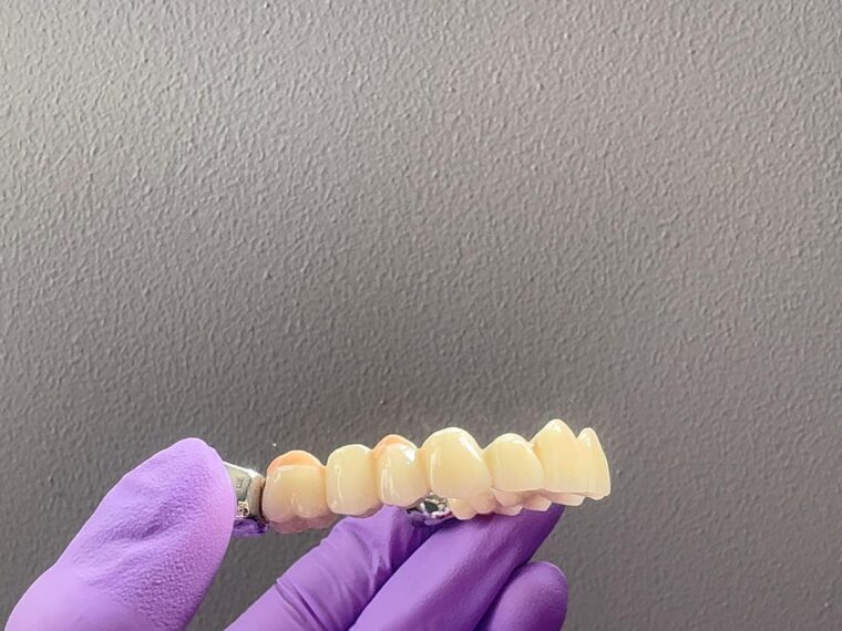 Caz clinic înainte de tratament — punte metalo-ceramică