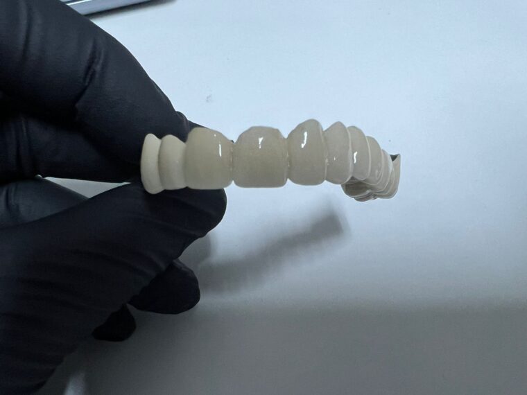 Coroane din zirconiu realizate CAD/CAM în laboratorul propriu