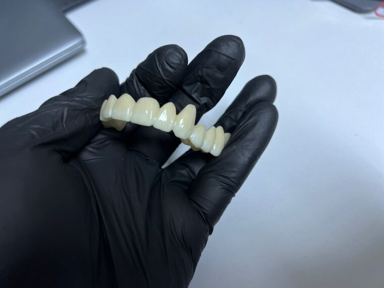 Lucrare fixă din zirconiu cu aspect natural