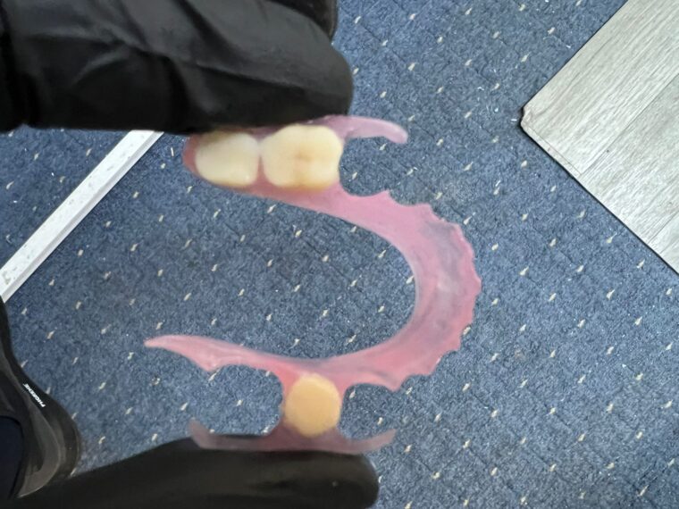 Detaliu proteză elastică realizată în laboratorul propriu