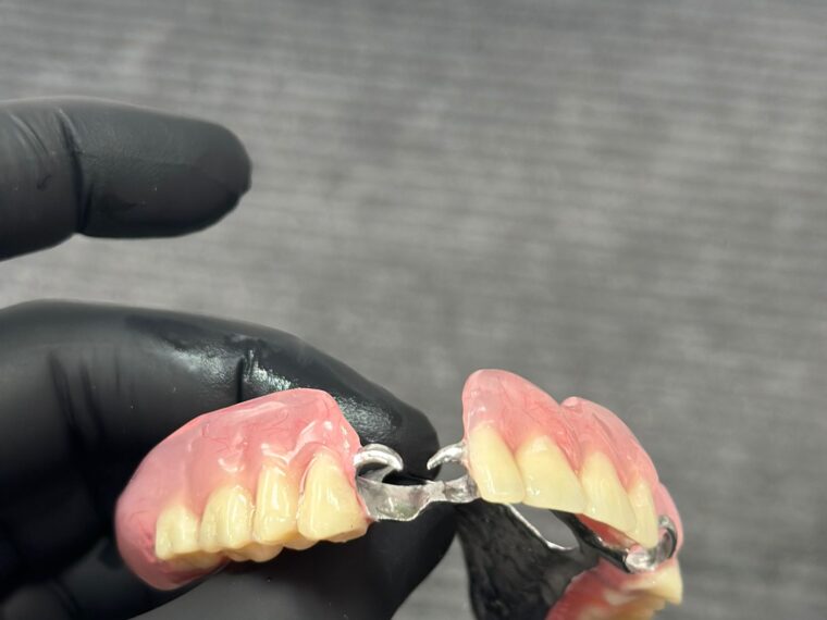 Proteză scheletată finalizată în laboratorul Yess Dental